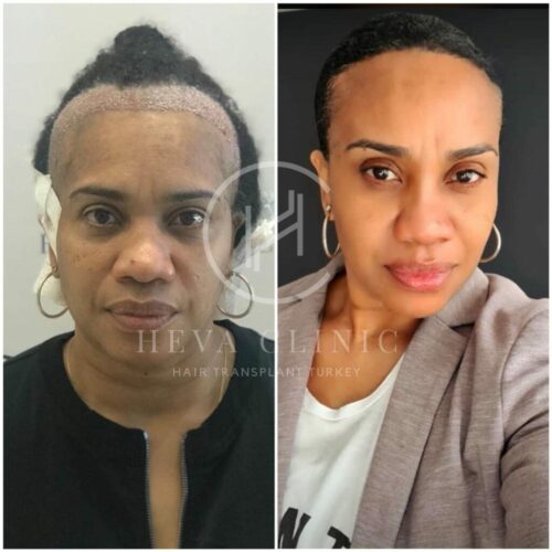 female-afro-before-after-3227-grafts-photo