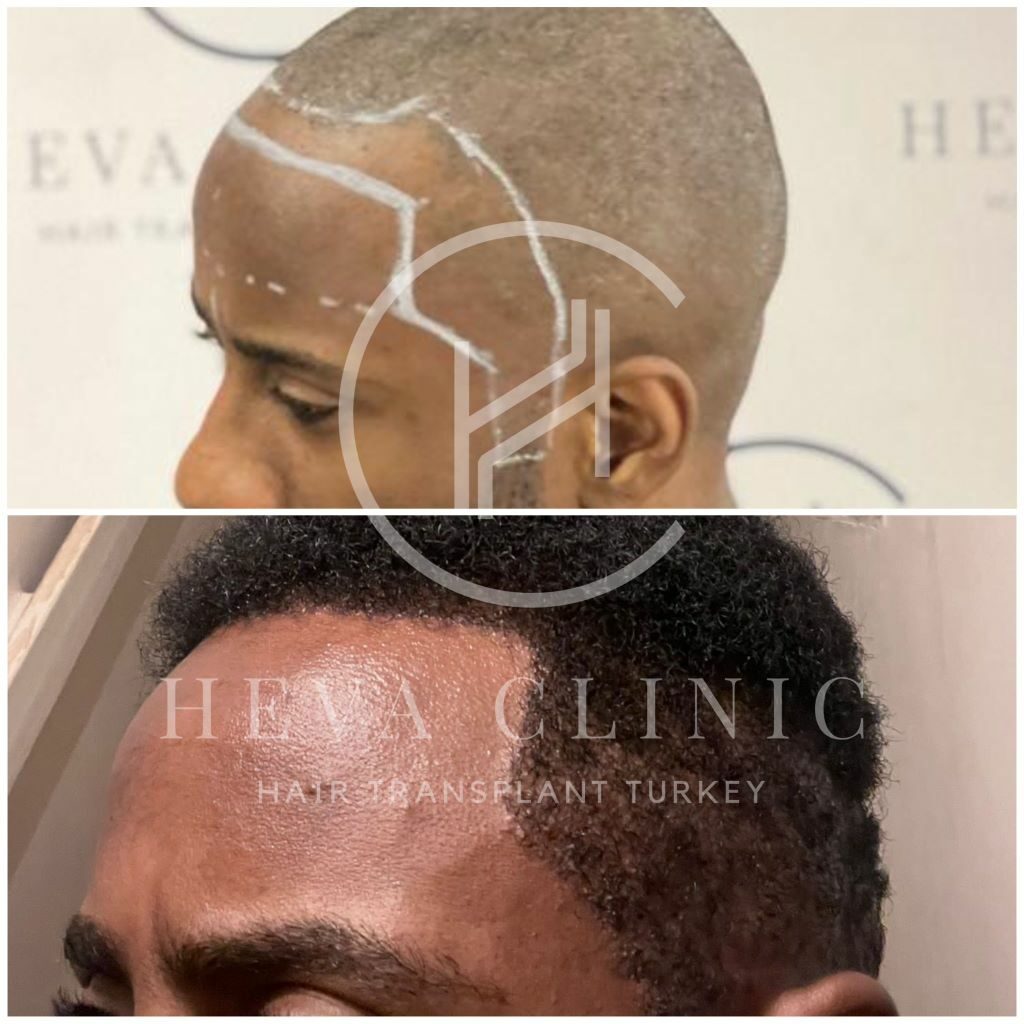 frontline hair transplant before and after afro transplant