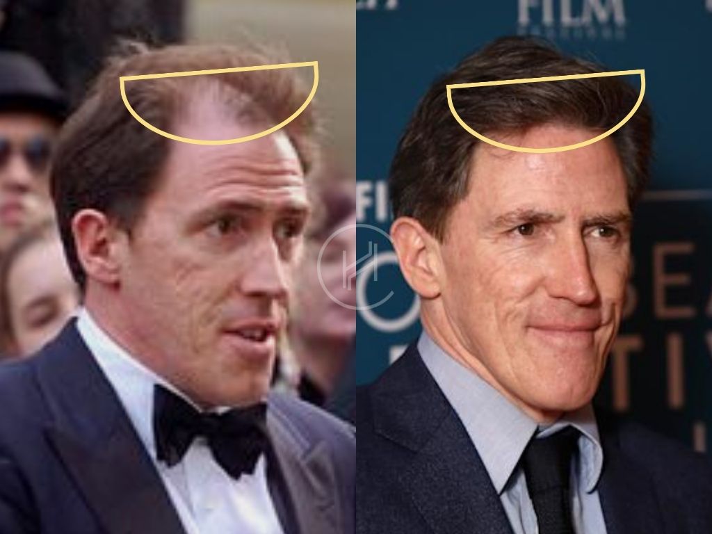 hair Transplant celebrities rob brydon uk