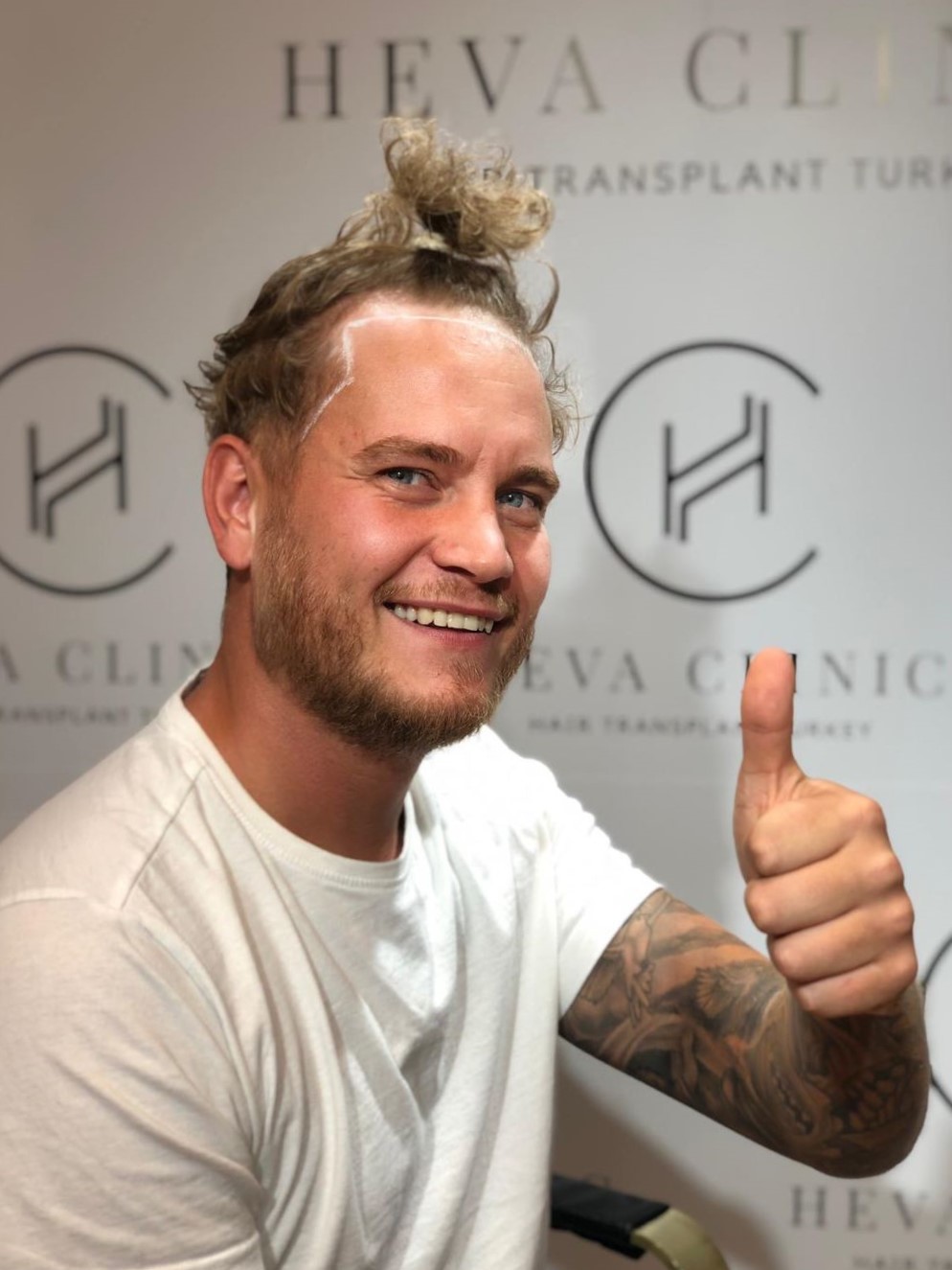 hair transplant patient from the UK to Turkey