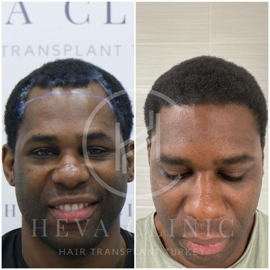 hairline afro transplant before & after 2000 grafts