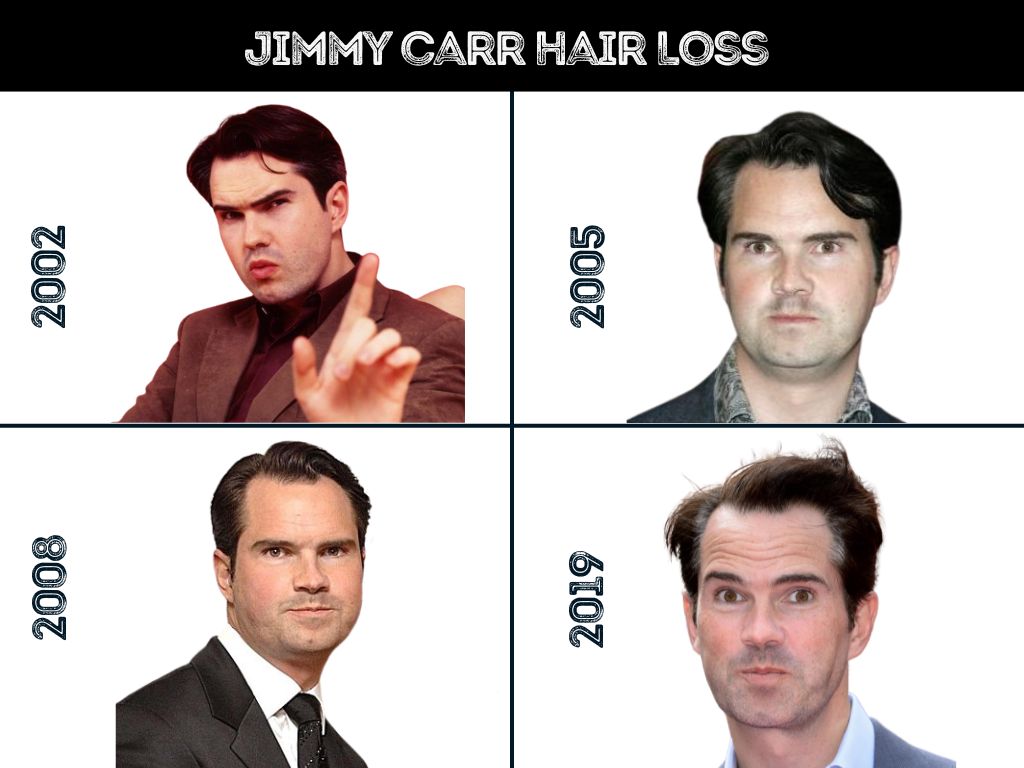 jimmy carr Hair Loss throughout the years