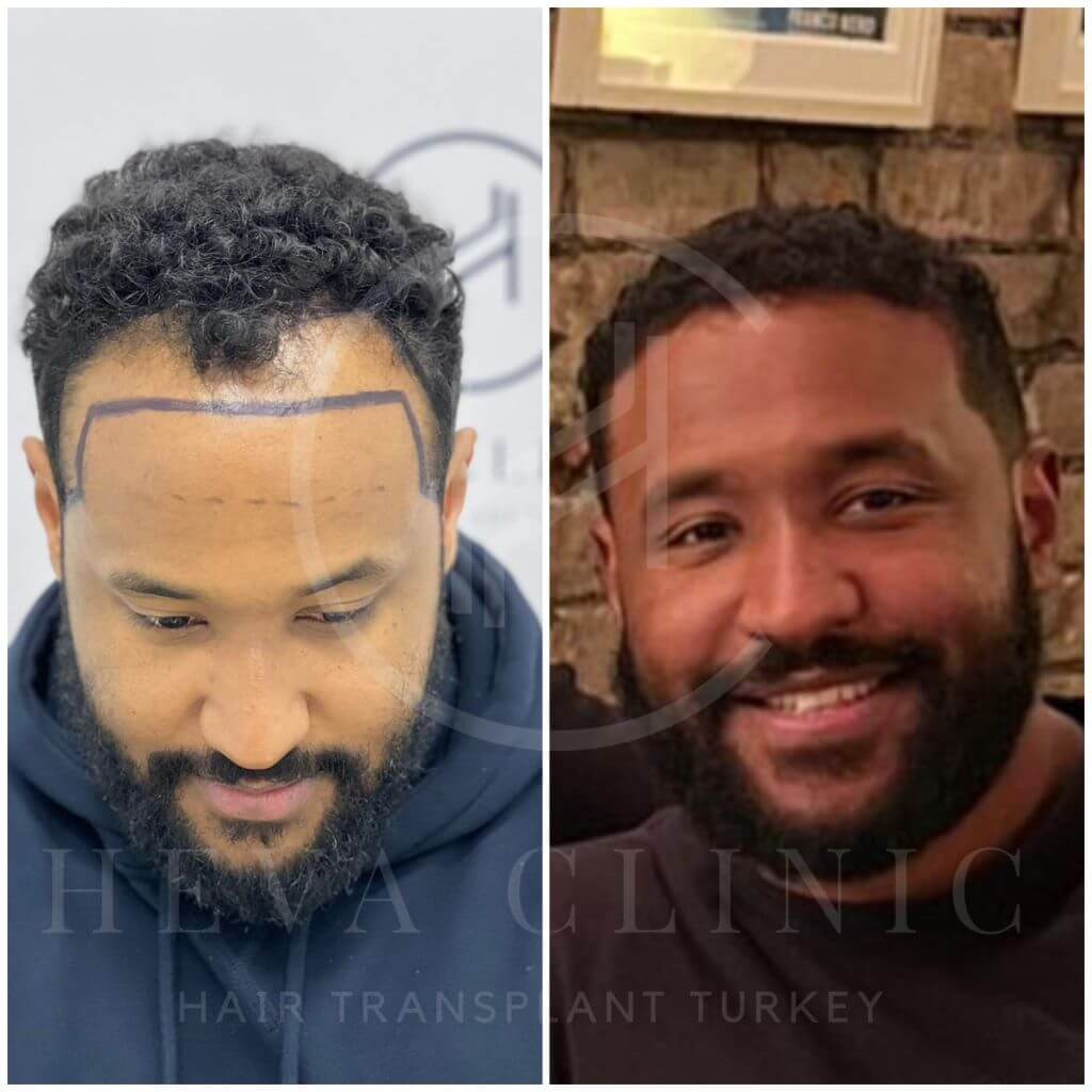 2700 grafts afro hair transplant before and after