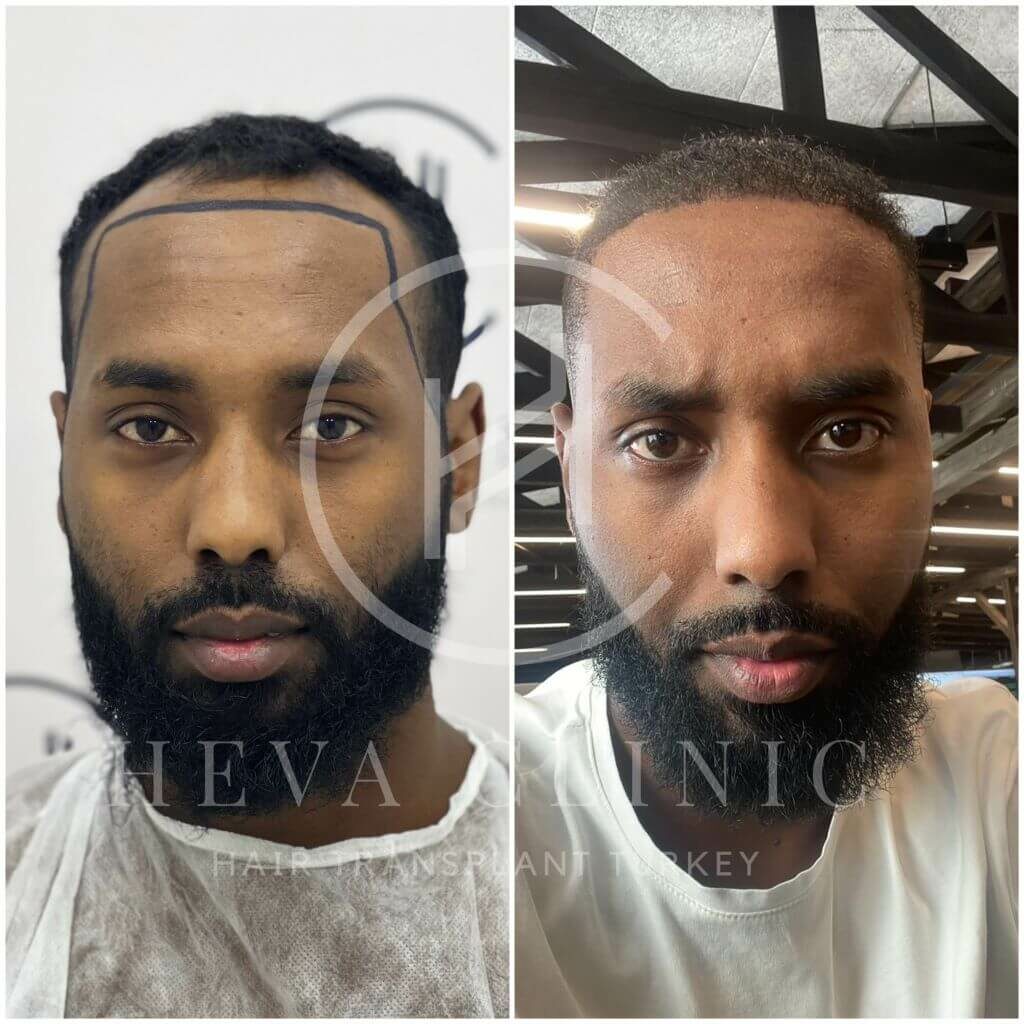 Afro Hair Transplant Before & After Photos - Unfiltered Results