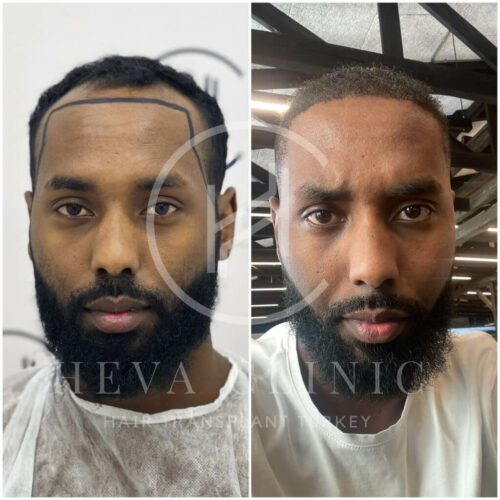 3500 grafts afro hair transplant result