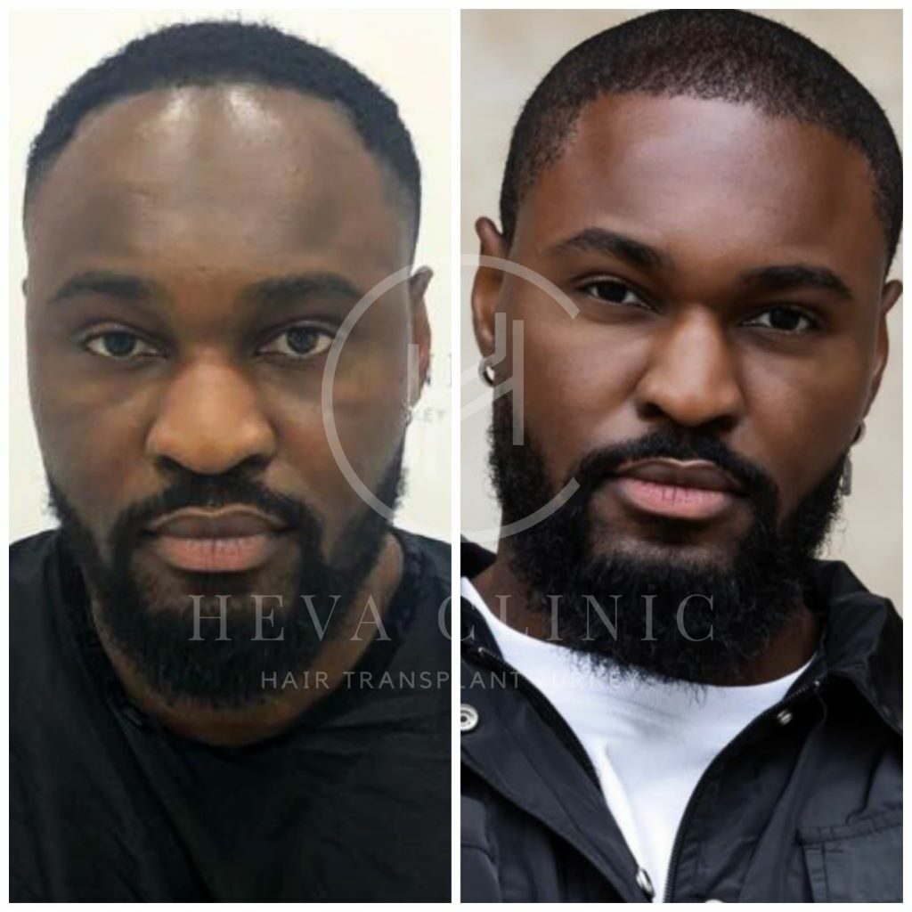 Afro textured 2500 grafts hair transplant result