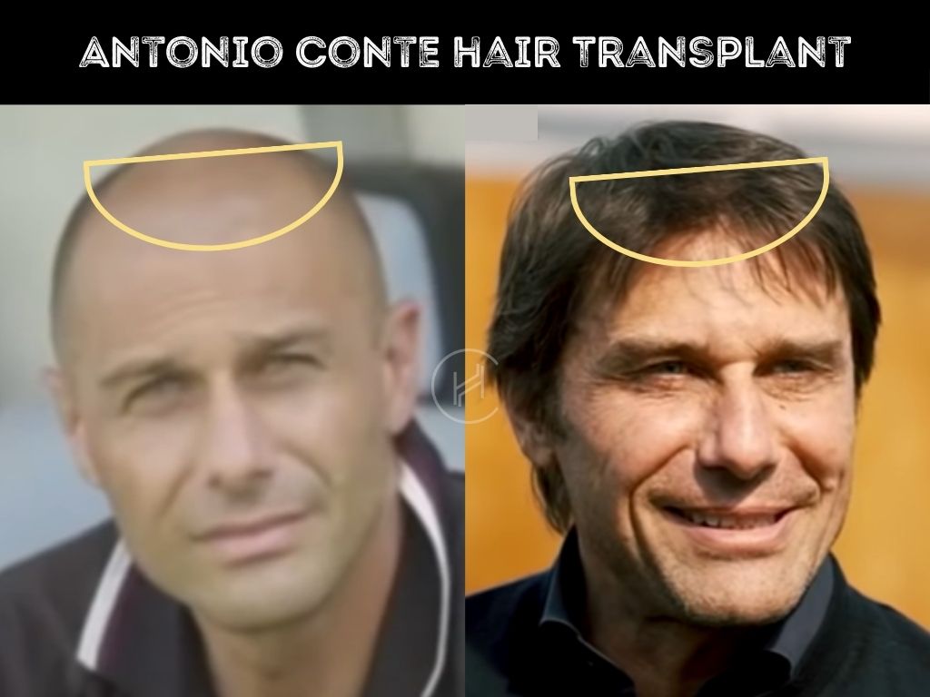 Antonio Conte Hair Transplant Bald to Full Hair