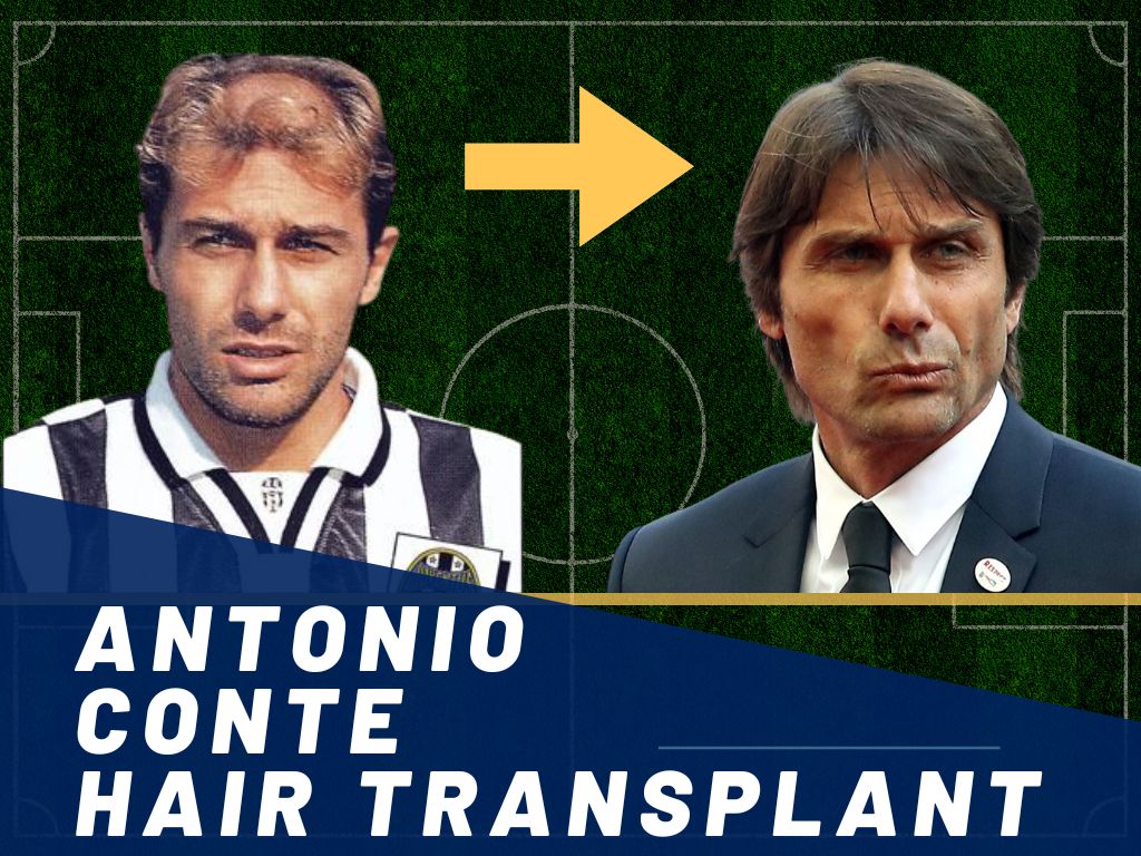 Antonio Conte Hair Transplant Banner
