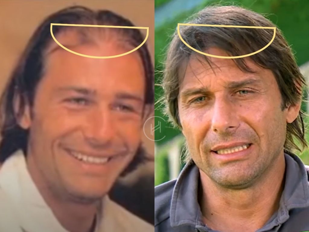 Antonio Conte Hair Transplant Before and After