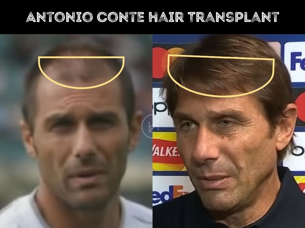 Antonio Conte Hair Transplant Result
