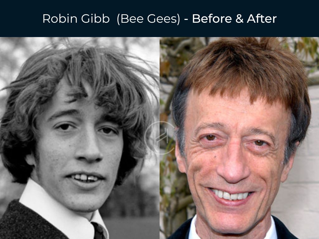 Bee Gees - Dental Before & After
