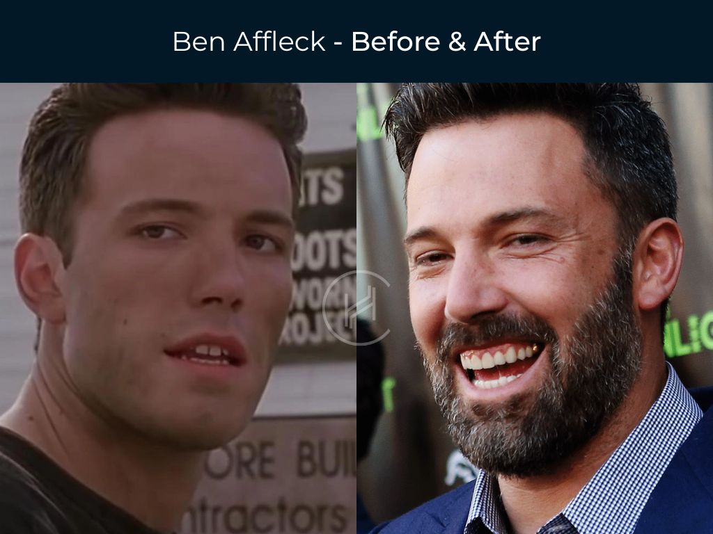Ben Affleck - Dentures Before & After