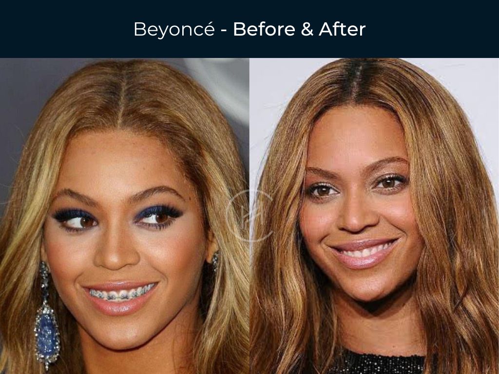 Beyoncé - Dental Braces Before & After