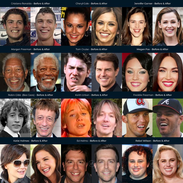 Celebrity before And After Dentures