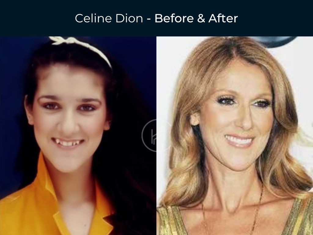 Celine Dion - Dental Before & After