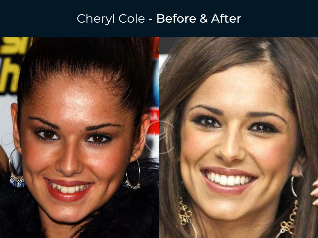 Cheryl Cole - Dental Before & After
