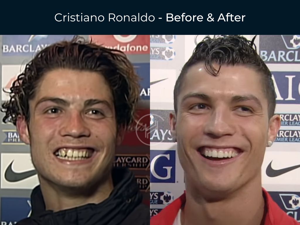 Cristiano Ronaldo - Dental Before & After