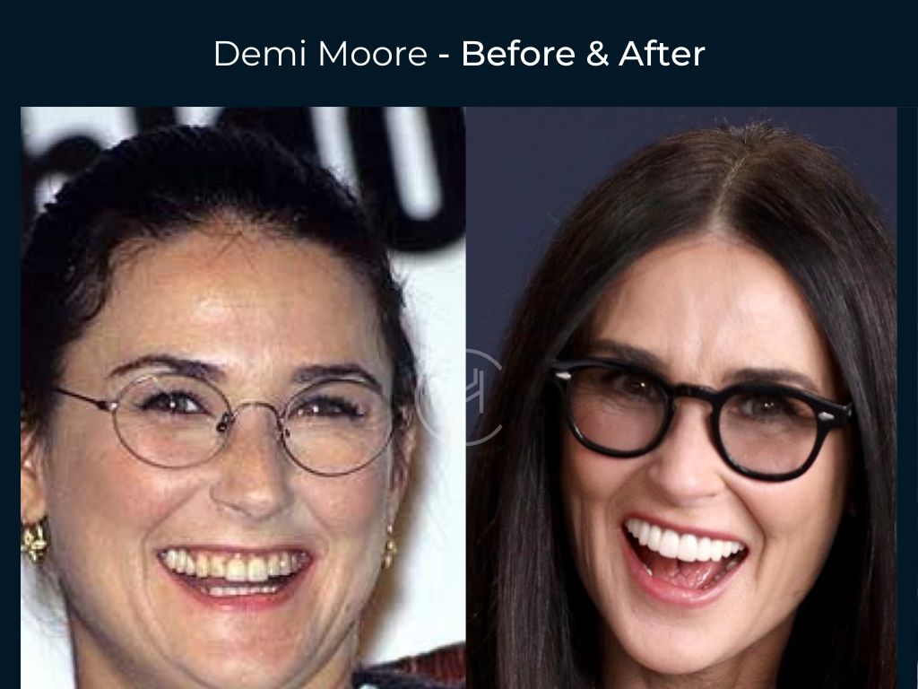 Demi Moore - Dental Before & After