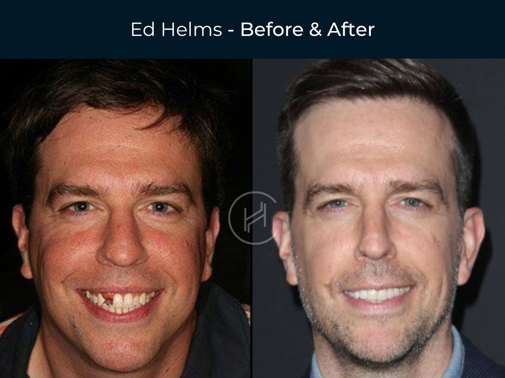 Ed Helms - Dental Missing Teeth Before & After