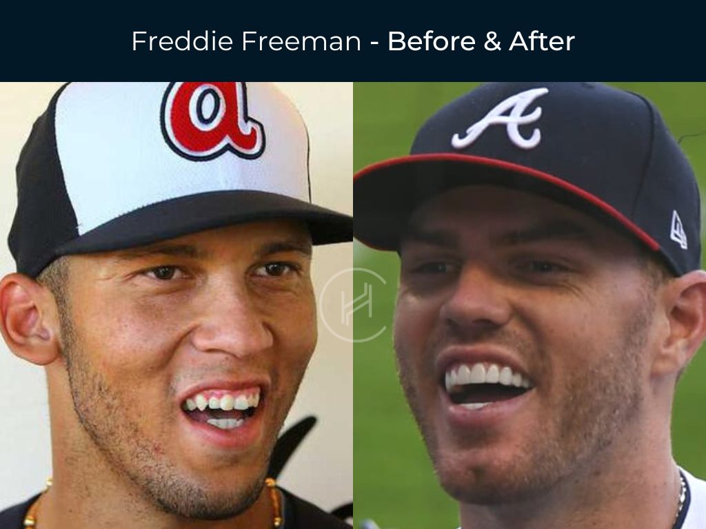 Freddie Freeman - Dental Veneers Before & After