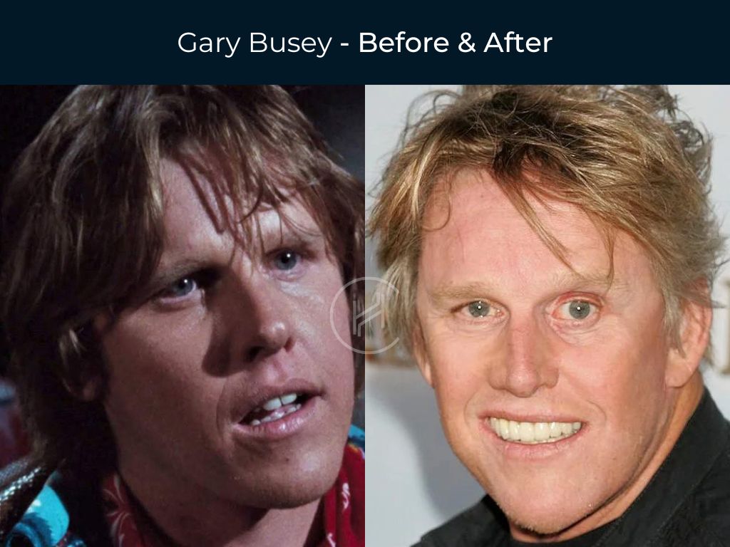Gary Busey - Dental Before & After