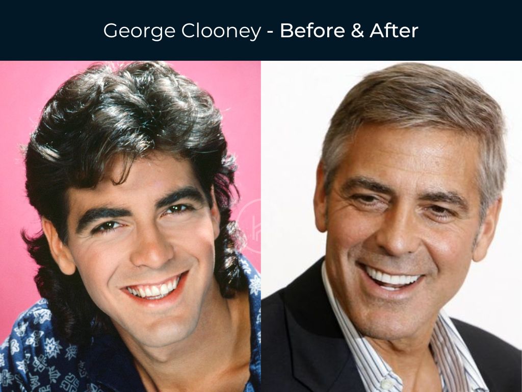 George Clooney - Dental Before & After