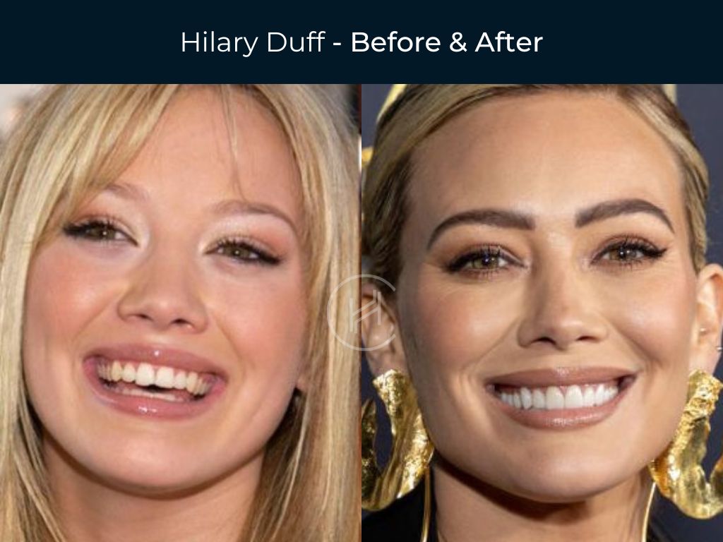 Hilary Duff - Dental Before & After