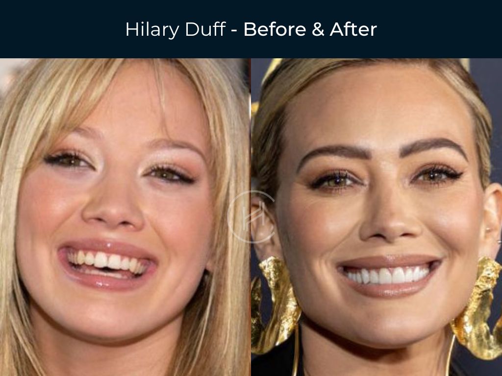 Celebrity Dental Implants And Veneers Before And After Photos