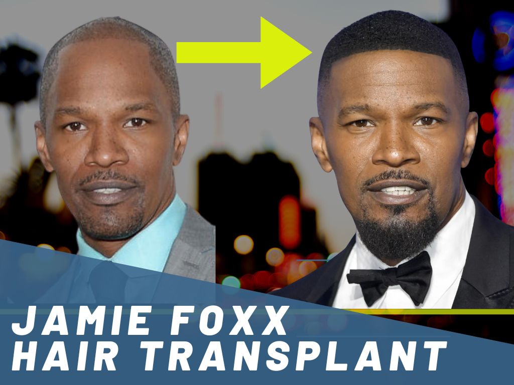 Jamie Foxx Hair Transplant Banner