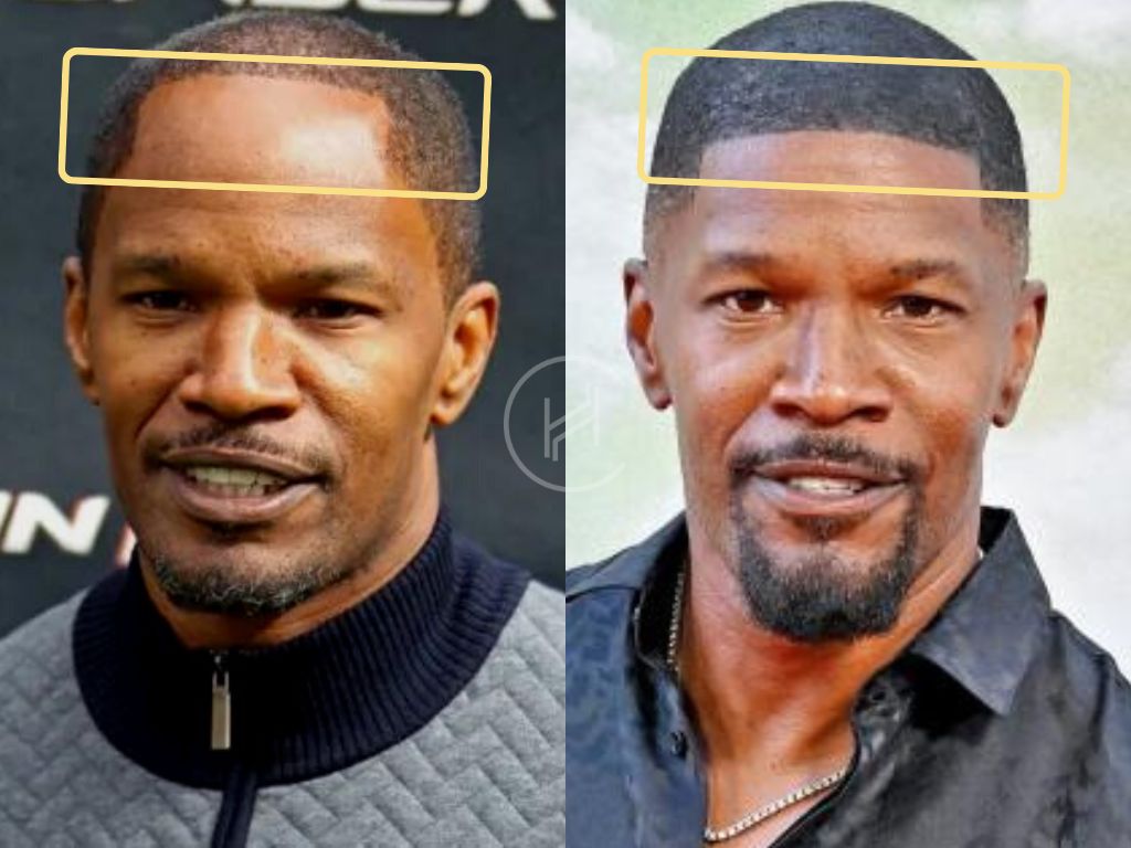 Jamie Foxx Hair Transplant Before and After Hair Line
