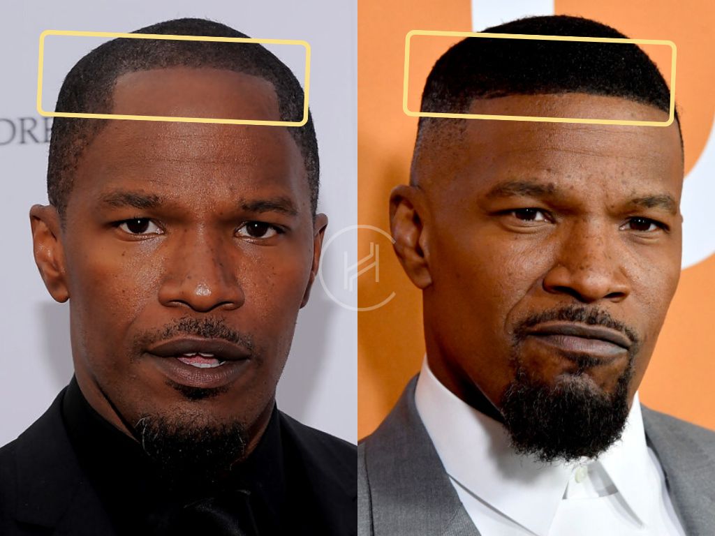 Jamie Foxx Hair Transplant Result Before & After