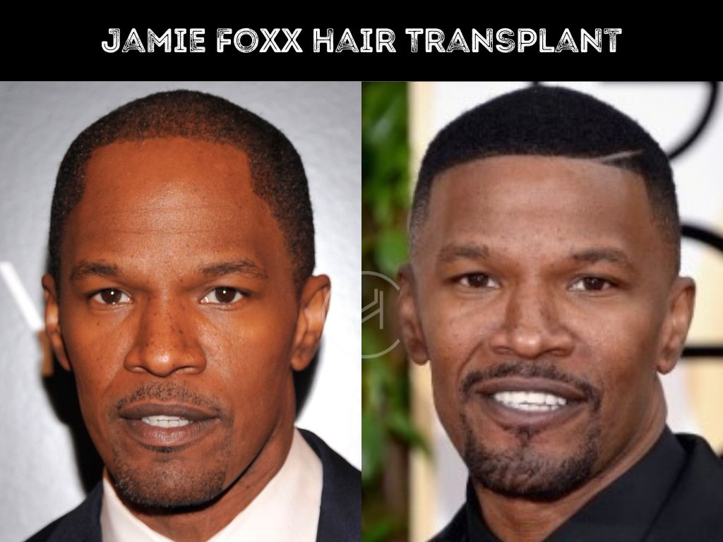 Jamie Foxx Hair Transplant