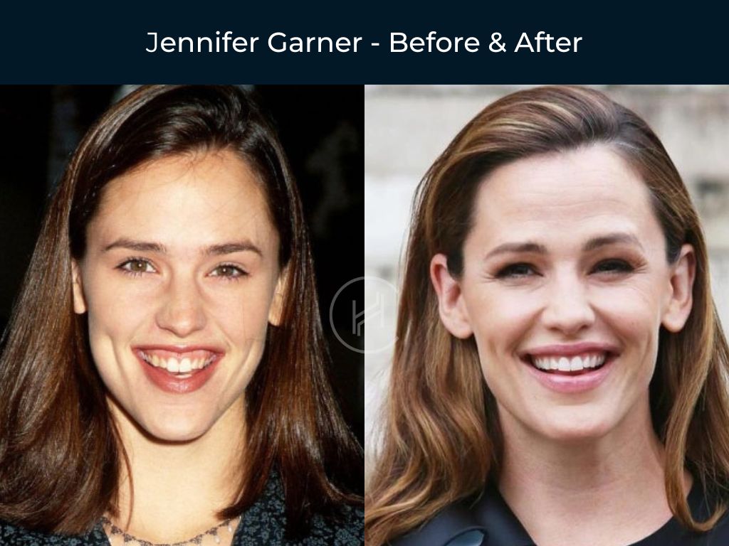 Jennifer Garner - Dentures Before & After