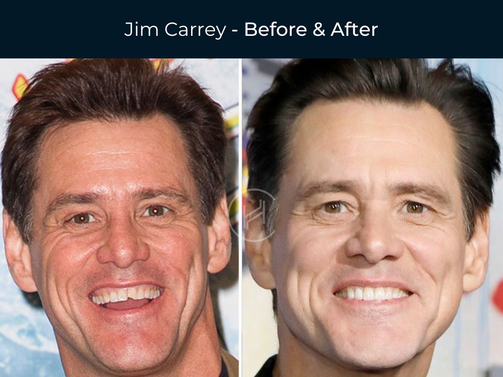 Jim Carrey - Dental Before & After Chipped Teeth