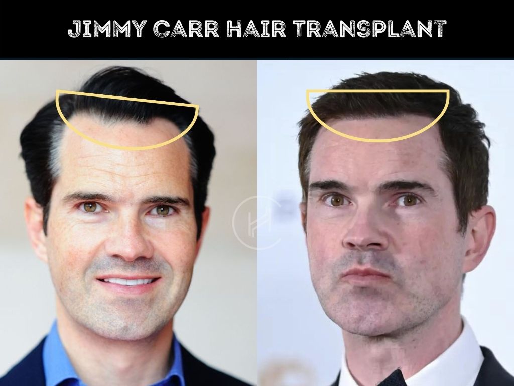 Jimmy Carr Before And After Hair Transplant