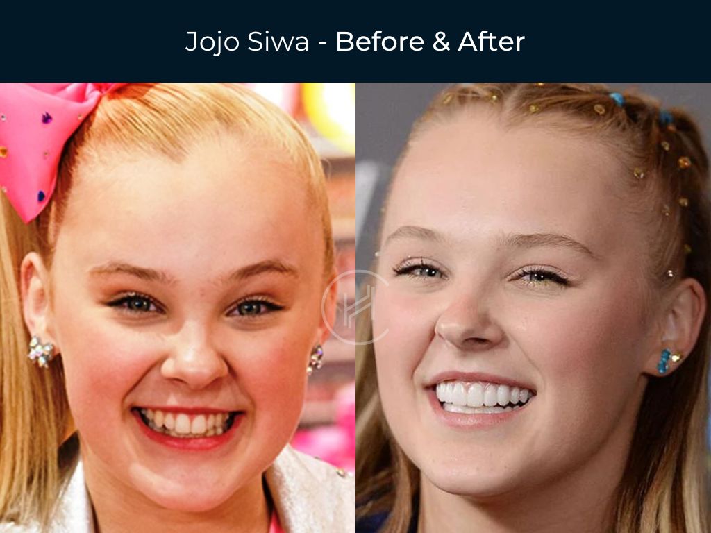 Jojo Siwa - Dental Before & After