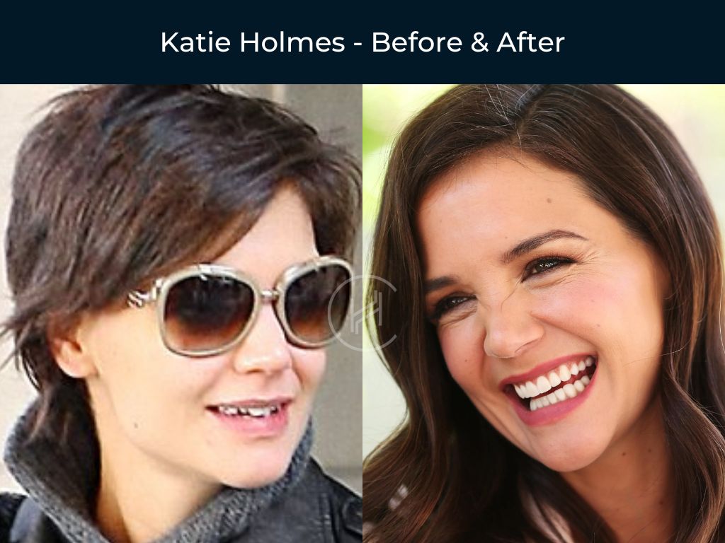 Katie Holmes - Dental Veneers Before & After