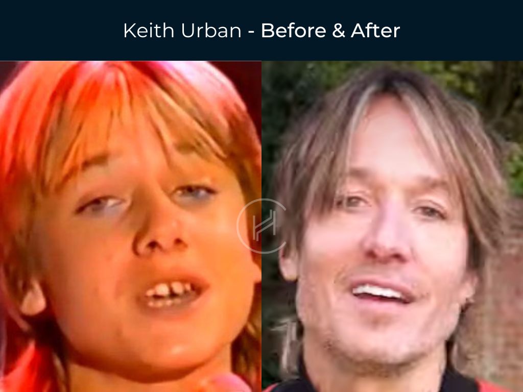 Keith Urban - Dental Before & After
