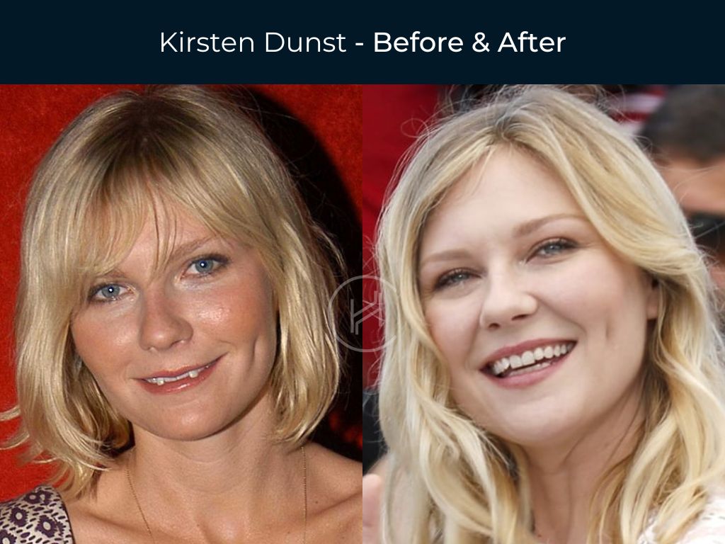 Kirsten Dunst - Dental Before & After