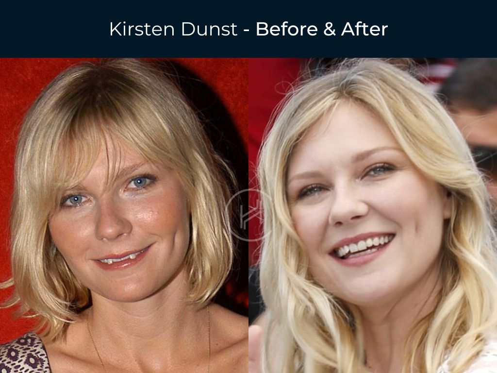 Celebrity Dental Implants And Veneers Before And After Photos