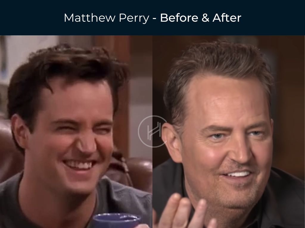 Matthew Perry - Dental Smile Before & After