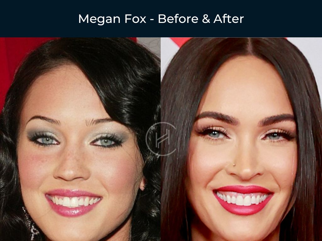 Megan Fox - Dental Before & After