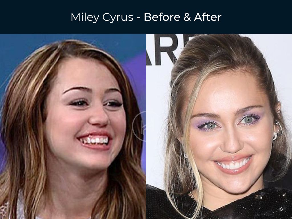 Miley Cyrus - Dental Before & After