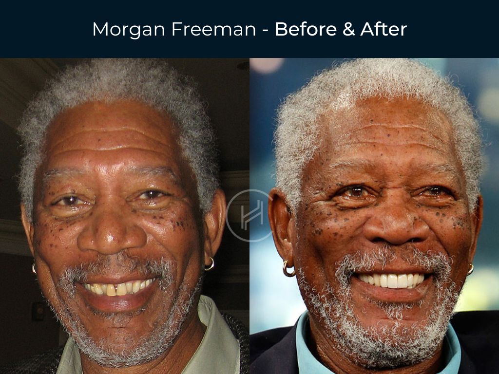 Morgan Freeman - Dental Before & After