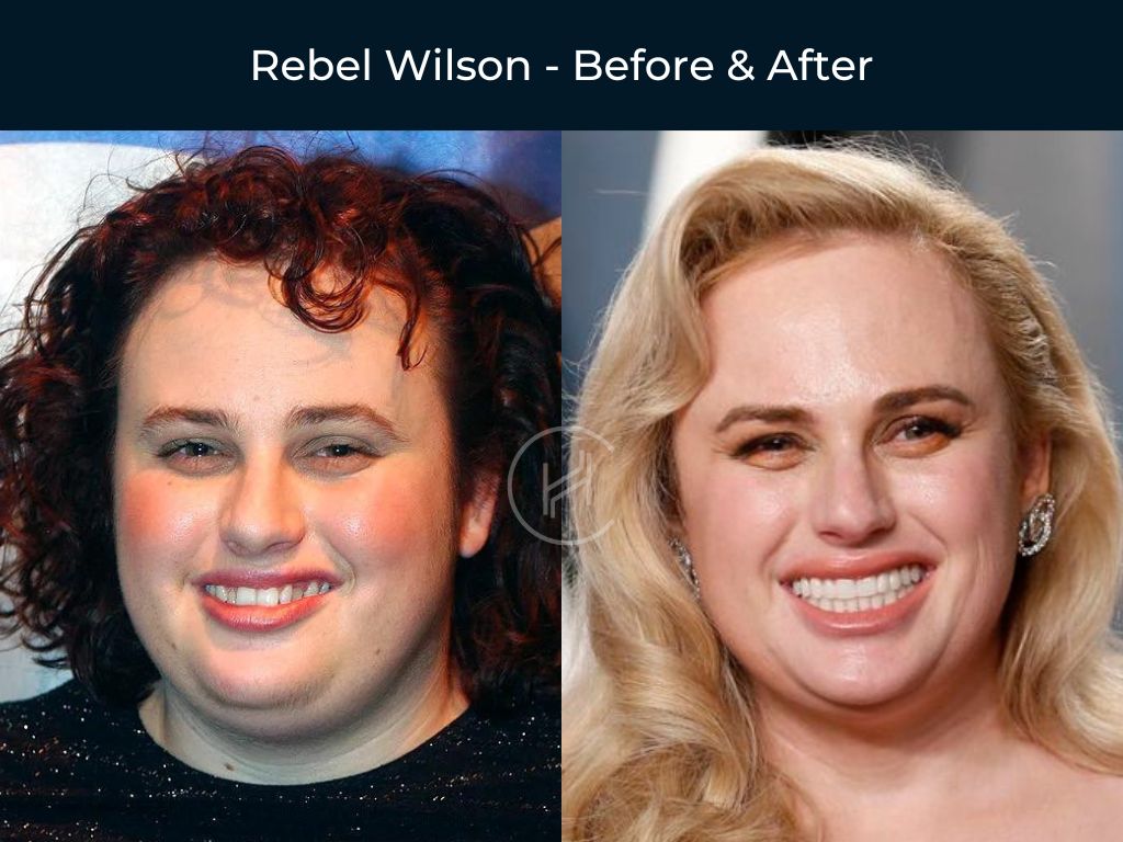 Rebel Wilson - Crooked Teeth Dental Before & After