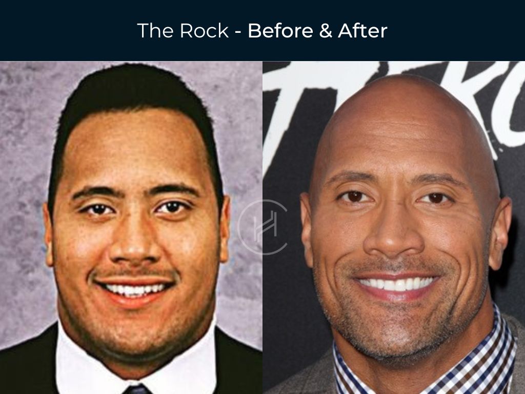The Rock - Dental Before & After