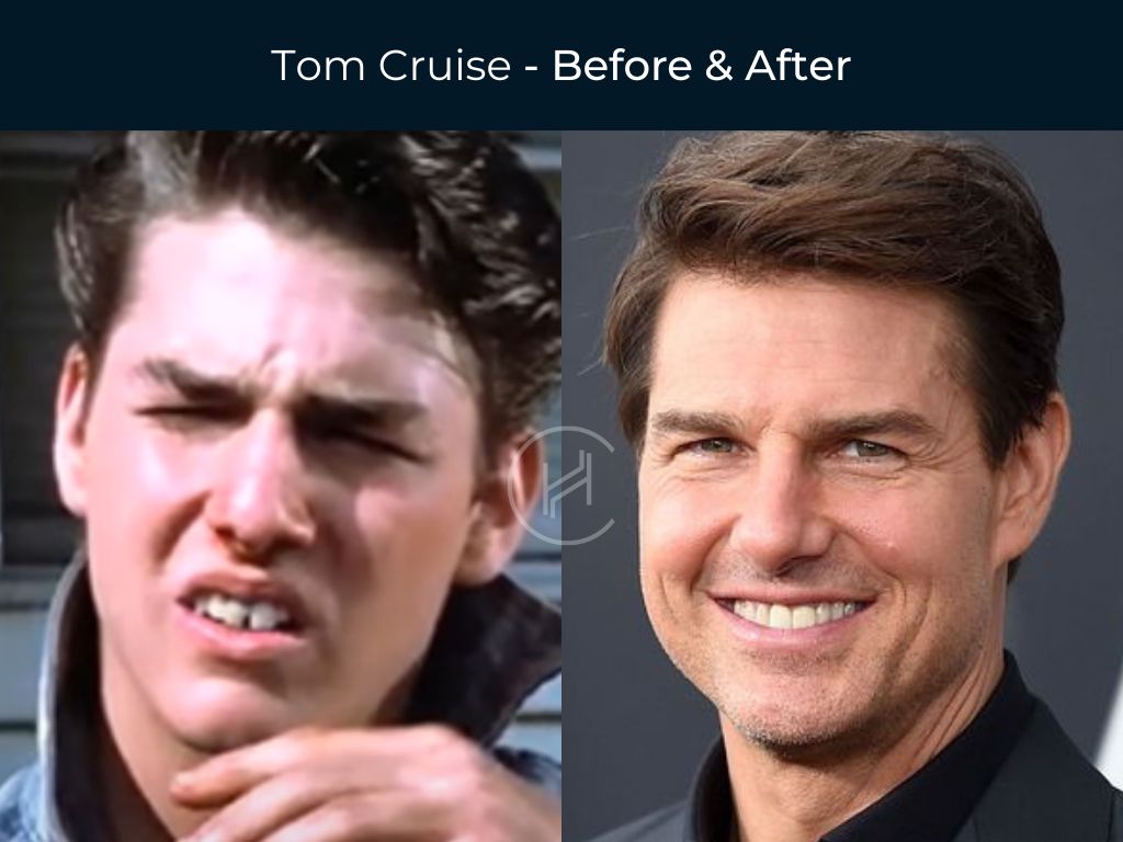Tom Cruise - Dental Work Before & After