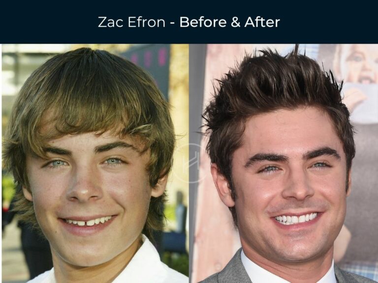 26 Celebrity Dental Implants and Veneers Before and After Photos