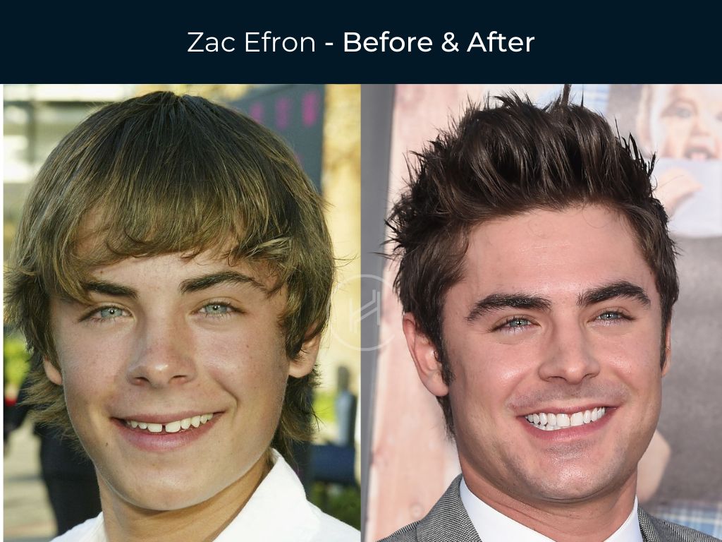 Zac Efron - Dental Before & After