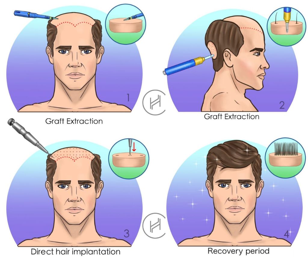 dhi-hair-transplant-process-steps-square